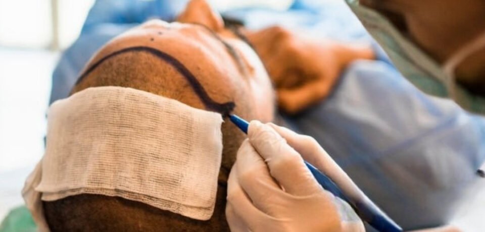 Hair Transplant In İstanbul