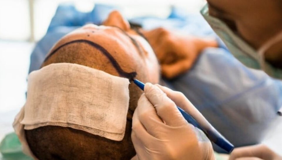hair-transplant-in-istanbul Hair Transplant In İstanbul