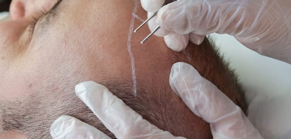 Hair Transplant In İzmir