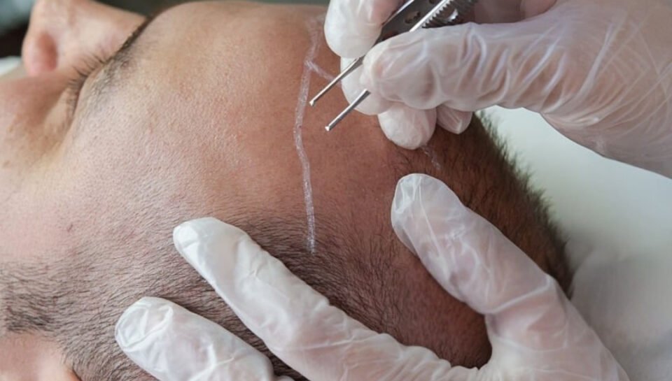 hair-transplant-in-izmir Hair Transplant In İzmir